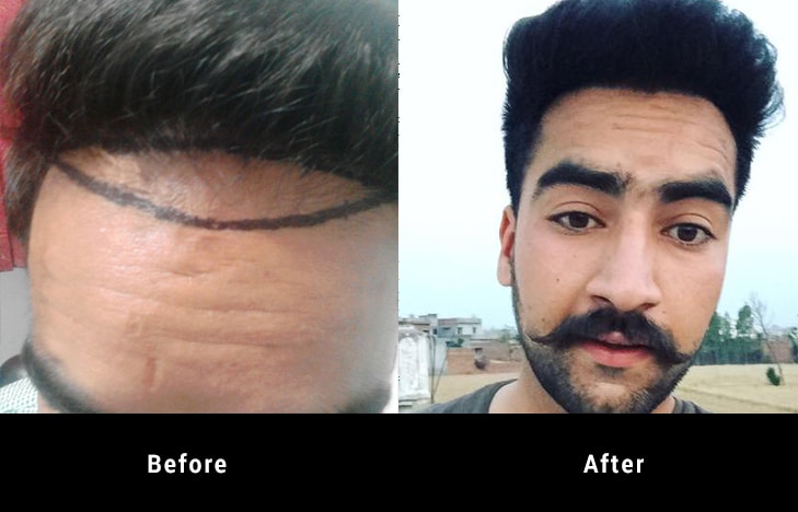 Before and after hair Transplant treatment