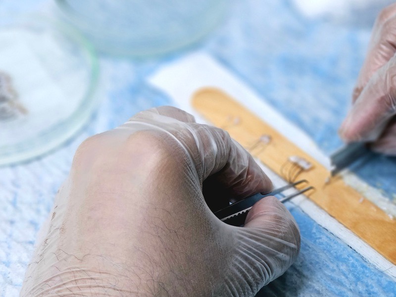 Follicular units being prepared for an FUE transplant