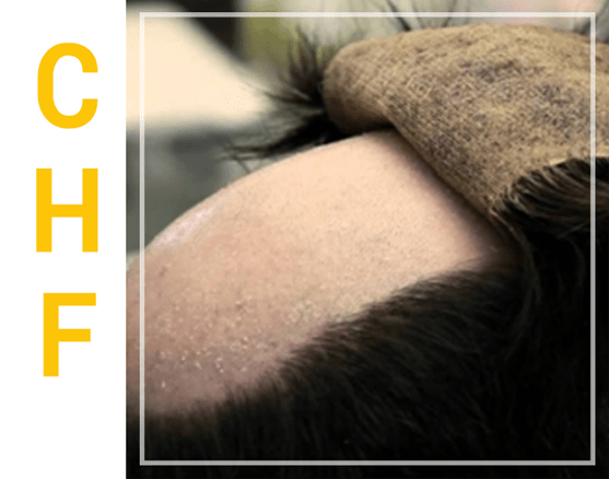 CHF hair restoration
